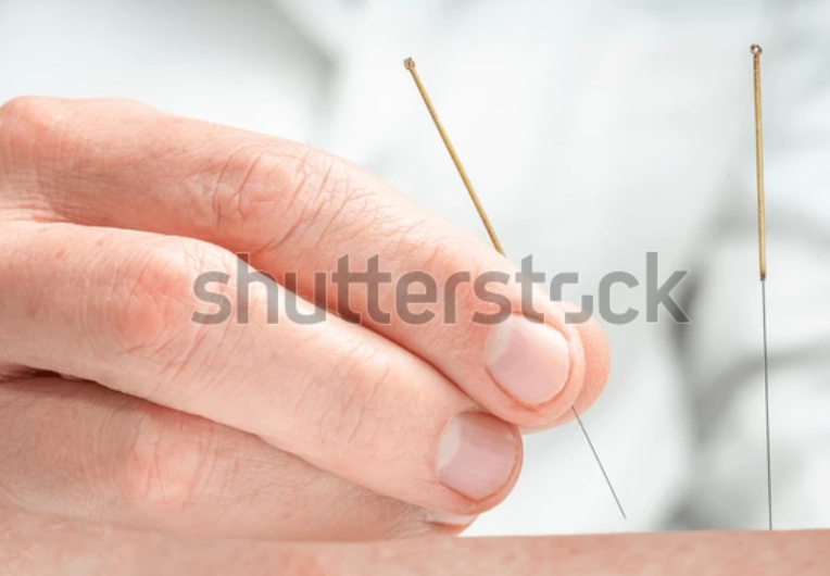 Acupuncture therapy